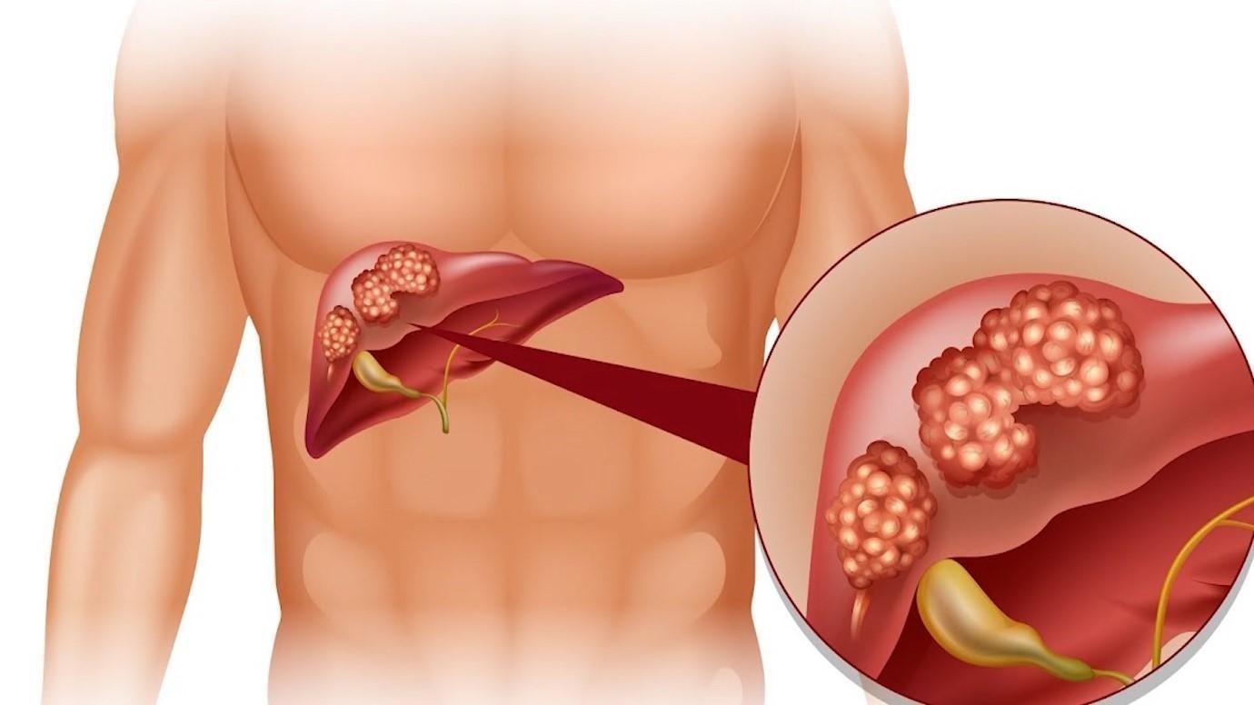 Tổng hợp các cách giúp hỗ trợ thải độc gan an toàn