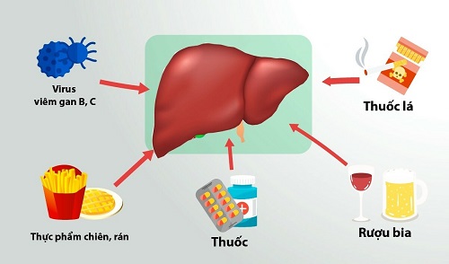 Bệnh suy gan: Nguyên nhân, triệu chứng, chẩn đoán và điều trị